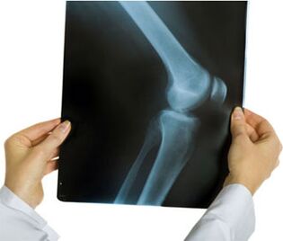 Radiografía da artrose do xeonllo